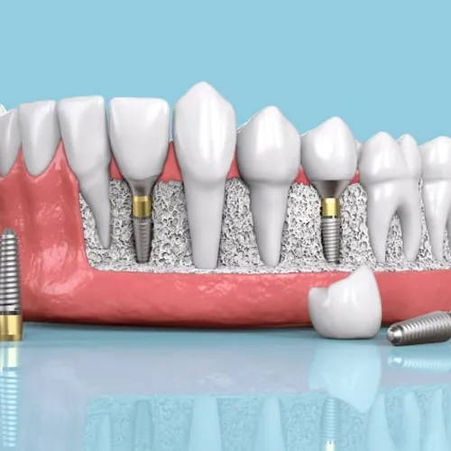 3D illustration of a denture with dental implants.