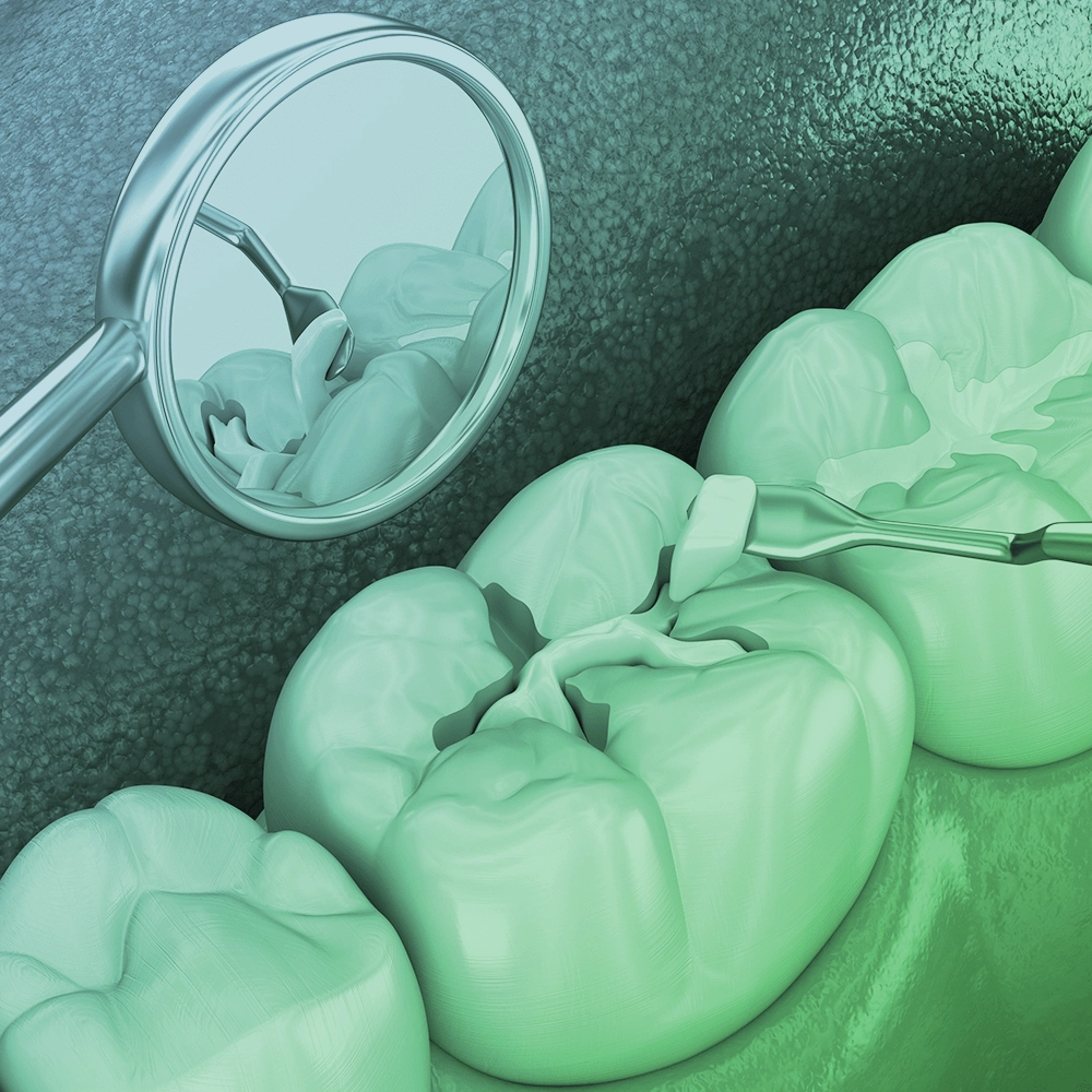 3D illustration of a dental filling.