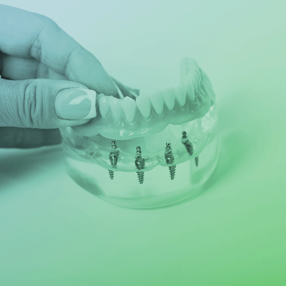 All-on-4 being placed on a denture model.